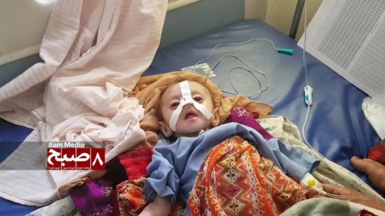 Rising Incidence of Pneumonia and Malnutrition in Nimruz Province
