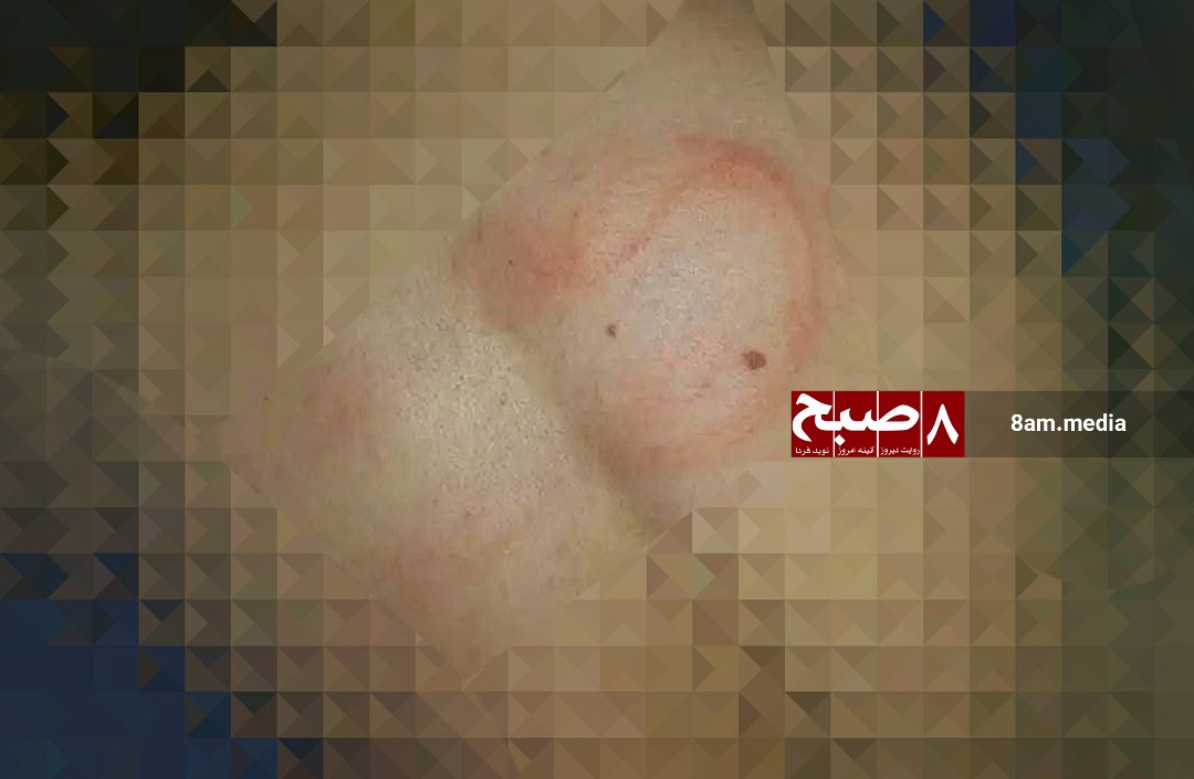 Whip marks on a student’s back in Kabul after punishment for not wearing a turban.(Exclusive)