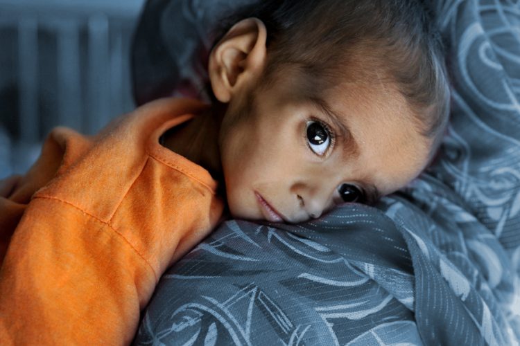 A visibly malnourished child lies in a hospital bed in Afghanistan, where 3.7 million children under five are projected to suffer from acute malnutrition in 2026. (Photo Credit: AFP)