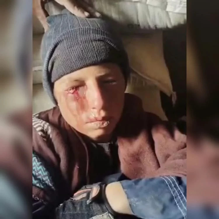 This child was injured in Spin Boldak, Kandahar, according to sources; they say his eye was injured after being struck by a stone. (Photo: Exclusive)