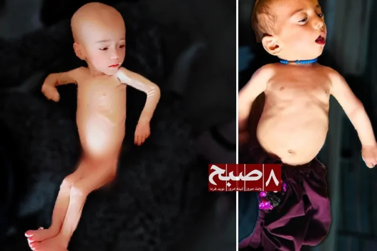 Two severely malnourished infants are shown in a collage highlighting the child malnutrition crisis in Faryab’s Gurziwan District. (Photo credit: 8am.media)