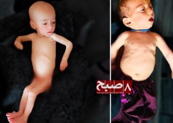 گرزیوان فاریاب؛ بیش از ۲۵۰ کودک در شش روستا با سوءتغذیه دست‌وپنجه نرم می‌کنند